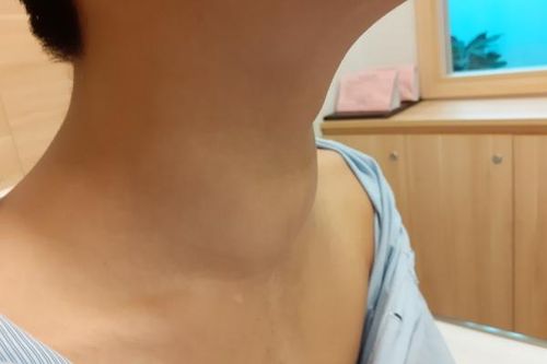 Thầy thuốc 'cân não' giải thoát khối ung thư tuyến giáp khủng di căn phổi hiếm gặp
