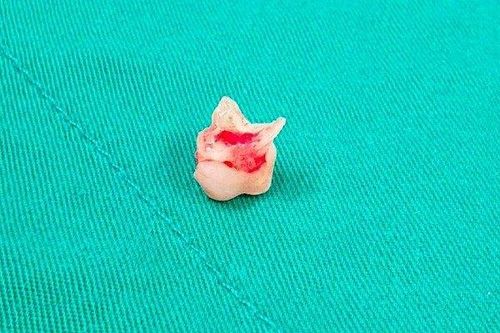 Chiếc răng sữa rơi vào phổi bé gái suốt 2 tháng sau khi tự nhổ tại nhà