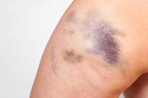 7 nguyên nhân phổ biến gây các vết bầm tím trên cơ thể