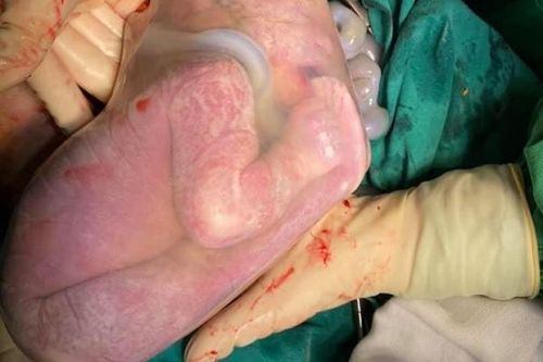 Ngắm em bé chào đời nằm nguyên trong bọc ối rất đáng yêu