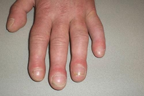 Những dấu hiệu ở móng tay cảnh báo bạn mắc bệnh nặng, có cả ung thư
