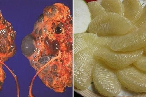 6 loại trái cây phổ biến giúp thải độc gan, lọc sạch thận ngừa ung thư hiệu quả