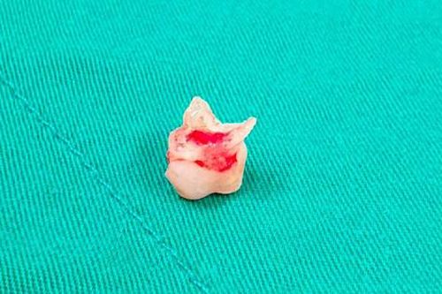 Răng sữa mắc kẹt trong phế quản bé gái 8 tuổi
