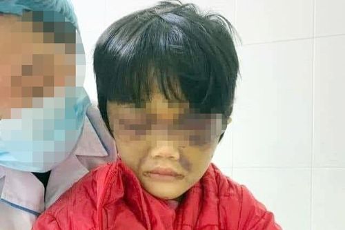 Sức khỏe bé gái 6 tuổi bị mẹ bạo hành ở Hải Dương giờ ra sao?