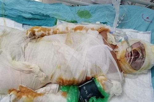 Mẹ chết cháy, con bỏng nặng nguy kịch cần giúp đỡ khẩn