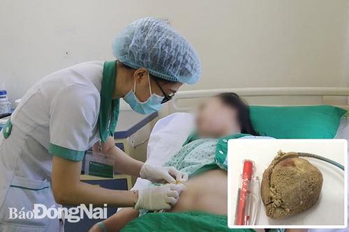 Sỏi 'khủng' trong bàng quang người phụ nữ