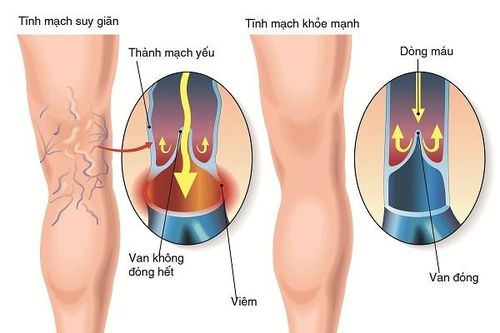 Đông y chữa suy giãn tĩnh mạch chân