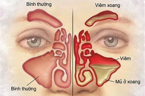 Dùng thuốc khi bị viêm mũi xoang