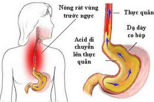 Ợ chua, dùng thuốc gì?