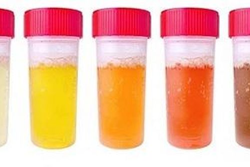 Màu nước tiểu: 5 cảnh báo cần đề phòng