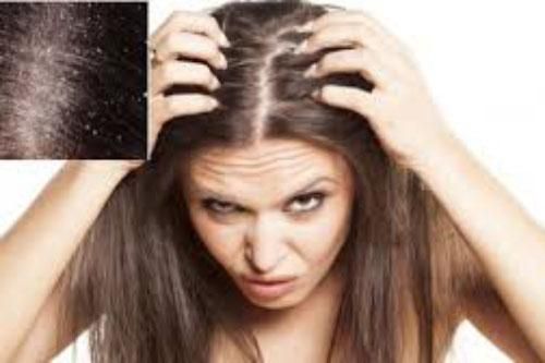 Dùng 'thần dược' siêu rẻ này để gội đầu đảm bảo hết sạch 90% gàu trong lần gội đầu tiên