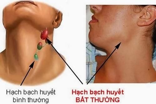 Thuốc mới trị ung thư hạch tái phát, kháng trị: Một số cẩn trọng khi dùng