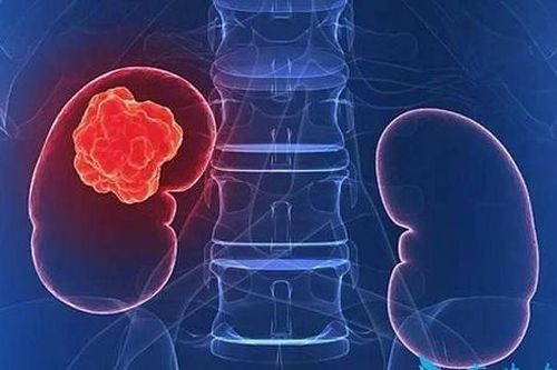 Thuốc mới trị ung thư thận tái phát: Phòng ngừa bất lợi của thuốc