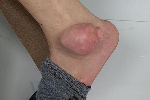 Cổ chân có khối u sưng to vì chữa gout bằng thuốc trên mạng