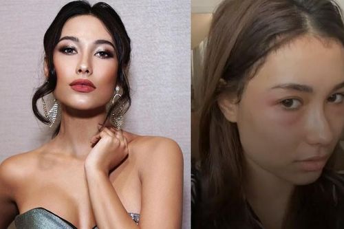 Hoa hậu Hoàn vũ Indonesia khổ sở vì bỏng mặt hậu thẩm mỹ