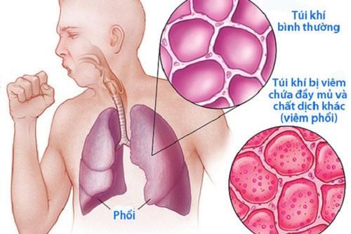 Dấu hiệu 'ba đen, hai đau' cảnh báo phổi đang tổn thương nặng nề, cần đi gặp bác sĩ ngay lập tức