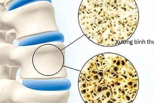 Những biến chứng đáng sợ của loãng xương bị nhiều người bỏ qua, hãy ngăn chặn ngay hôm nay!