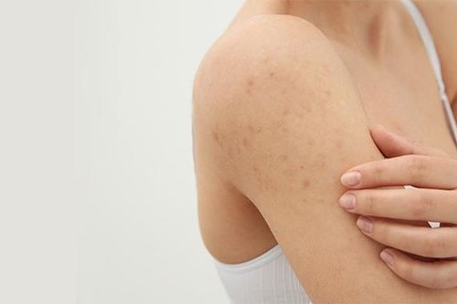 Các biểu hiện của bệnh viêm nang lông