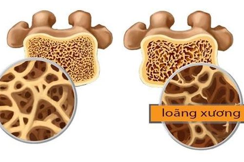 Nhận biết sớm bệnh loãng xương