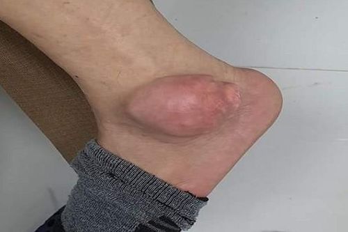 Chữa gout bằng thuốc trên mạng, bệnh nhân chân sưng to như quả ổi