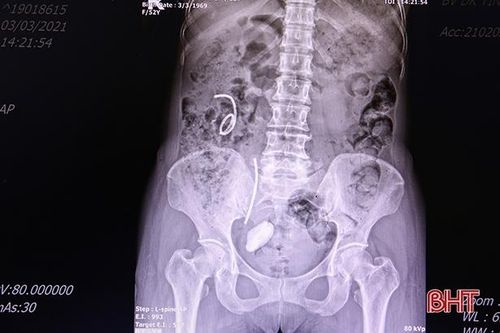 Một bệnh nhân Hà Tĩnh phải cắt bỏ thận vì quên sonde JJ trong niệu quản 3 năm