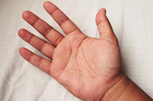 Những dấu hiệu ở lòng bàn tay cảnh báo bệnh nguy hiểm