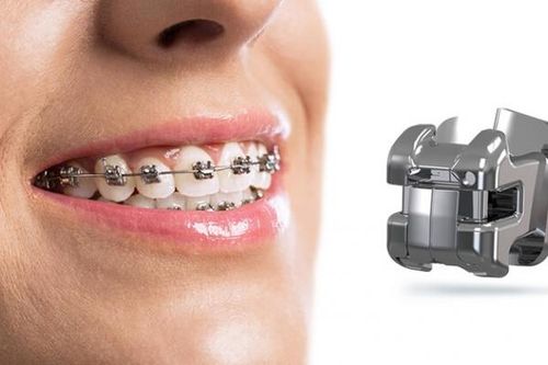 Top 4 loại niềng răng được ưa chuộng hiện nay