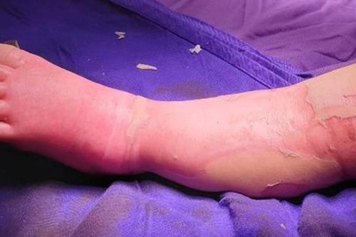 Một trẻ nhỏ tử vong vì đắp thuốc của thầy lang chữa bỏng
