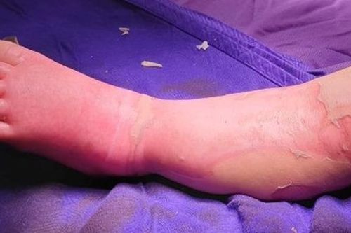 Đắp thuốc lá chữa bỏng, bé 9 tháng tuổi tử vong thương tâm