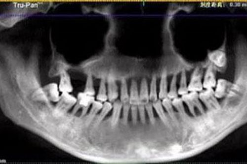 Cô gái 28 tuổi rụng răng, móm mém như cụ bà 80 vì thói quen xấu này