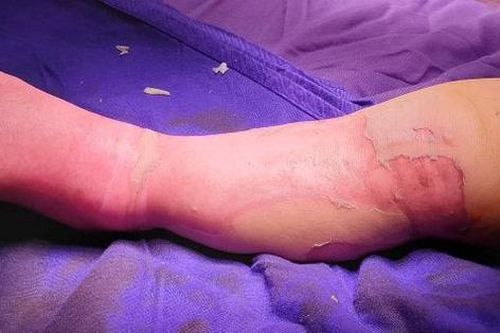 Bỏng nước sôi ở đùi và chân, gia đình đắp lá thuốc khiến trẻ tử vong