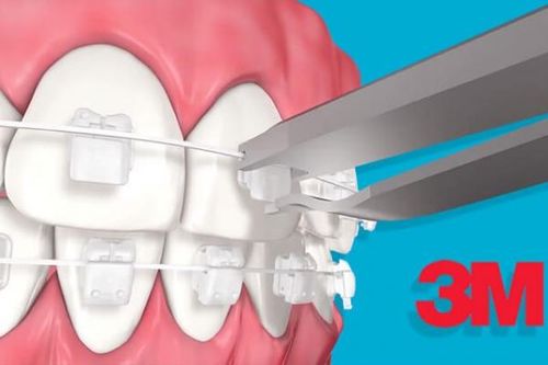 Ứng dụng công nghệ vào niềng răng thẩm mỹ
