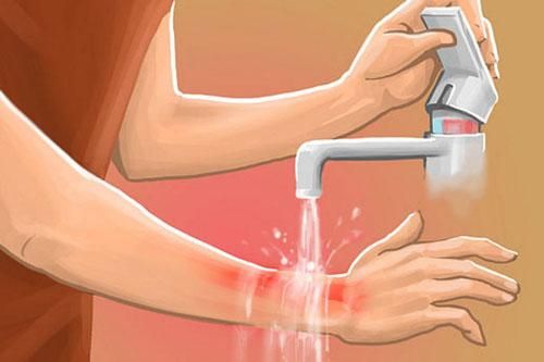 Những mẹo trị bỏng tại nhà vừa nhanh vừa hiệu quả: Mẹ đảm nên thủ sẵn trong bếp
