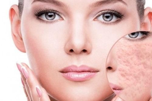 Cách trị các loại sẹo và làm đẹp da đơn giản bằng hành tây