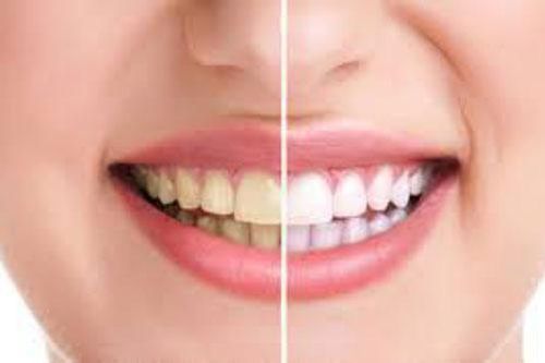5 loại đồ uống quen thuộc khiến răng xỉn màu, ngả vàng xấu xí