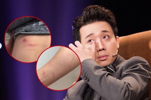 Trấn Thành khóc ròng vì bị khán giả cào đến rách da chảy máu