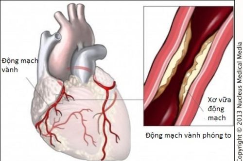 Dấu hiệu dễ nhận biết nhất các bệnh lý động mạch vành