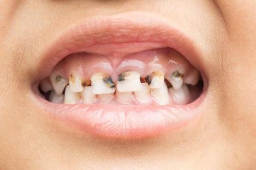 Hệ lụy khi thiếu hụt canxi