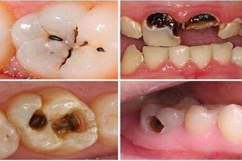 Sâu răng có thể làm tăng nguy cơ đột quỵ não