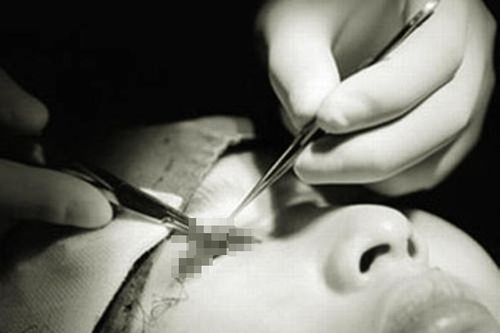 Cắt mí làm đẹp tại spa, cô gái trẻ mù một mắt, tính mạng bị đe dọa