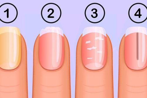 4 dấu hiệu lạ ở móng tay báo động bạn bị bệnh tiểu đường, nguy hiểm nhất là số 1