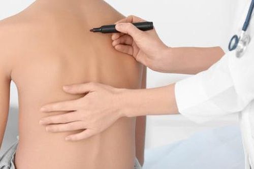 Từ vụ bé 13 tuổi bị vẹo cột sống, chuyên gia chỉ rõ dấu hiệu cảnh báo bệnh cần điều trị sớm
