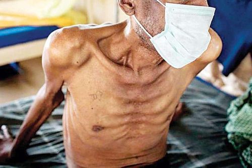 Ai có nguy cơ cao mắc bệnh lao?