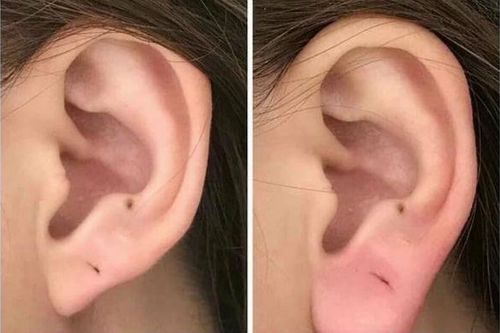 Tiêm quá nhiều filler để 'đổi vận', cô gái ở Hà Nội bị hoại tử tai