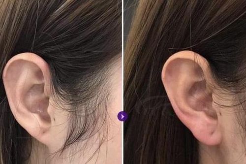 Tiêm filler vào tai để 'đổi vận', thiếu nữ phải nhập viện vì hoại tử