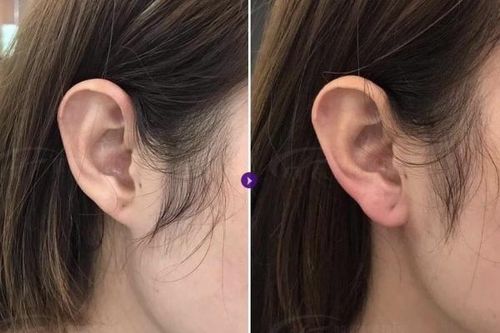 Tiêm filler vào vành tai, tài lộc chưa thấy đã phải viện xử lý hậu quả