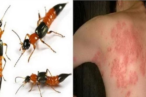 Giao mùa, đề phòng viêm da tiếp xúc do côn trùng