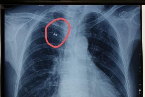 Gắp mảnh bom nằm trong lồng ngực 50 năm