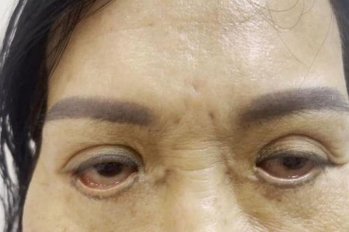 Mắt đỏ hoe, không nhắm được sau khi cắt mí 'chui'