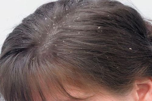 2 cách trị gàu cực dễ ai cũng làm được